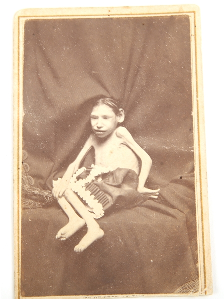 MID 19TH C. CDV OF A PERSON W/ A CONGENITAL DISABILITY