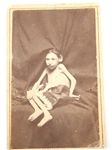 MID 19TH C. CDV OF A PERSON W/ A CONGENITAL DISABILITY